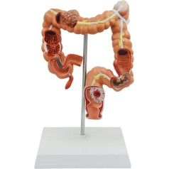 BJQZX Orgelmodell Anatomisches Modell Anatomisches Modell Einer menschlichen Dickdarmläsion Gastroenterologie-Dickdarmmodell